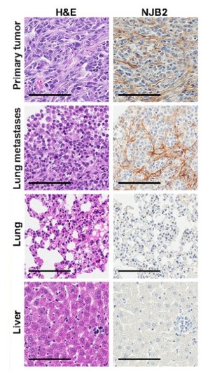 Fig.1 Schematic representation of EIIIB Expression at the tumors and metastatic sites by H&E staining and IHC using EIIIB antibody clone NJB2. (Jailkhani, et al., 2019)