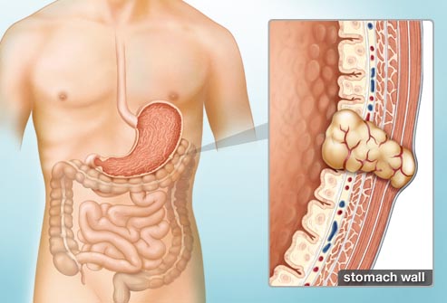 Gastrointestinal stromal tumors (GIST).