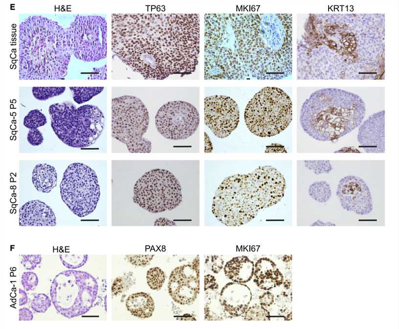 The patient-derived SqCa organoids and AdCa organoids recapitulate the histology of primary tumor tissue characterized using specific antiboies.