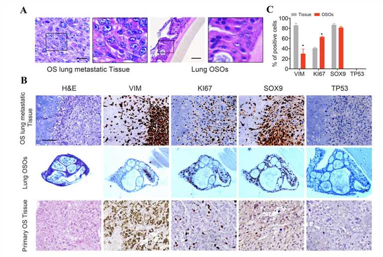 Osteosarcoma cancer organoids mimic the original patient's tumor on morphological and histological characteristics.