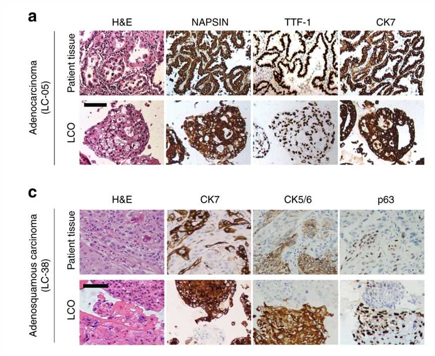 Lung cancer organoids retain the histological characteristics of separate initial tumor tissue validated by H&E staining and IHC analysis.