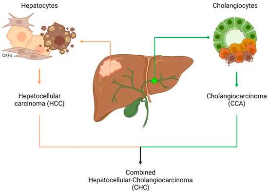 Subtypes of primary liver cancer.
