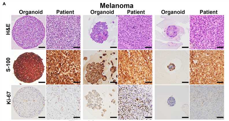 Melanoma organoids retain the histological and immunophenotype features of the parental tumor.