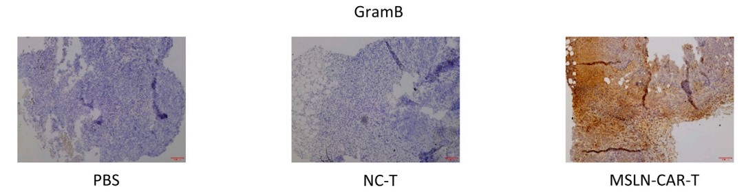 Treatment effect analysis of mice treated with anti-MSLN CART cells. Immunohistochemistry analysis of granzyme B in tumor sections.