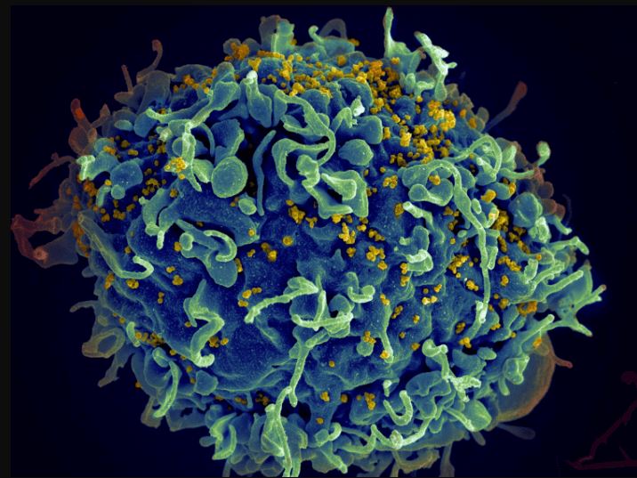 Image of a human T cell (blue) under attack by HIV (yellow).