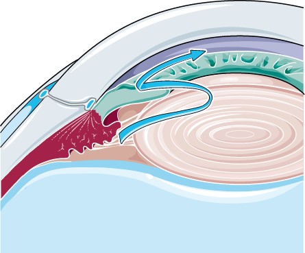 Angle-closure glaucoma pattern.