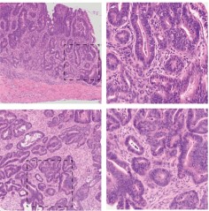 Colon tumor tissue sections.