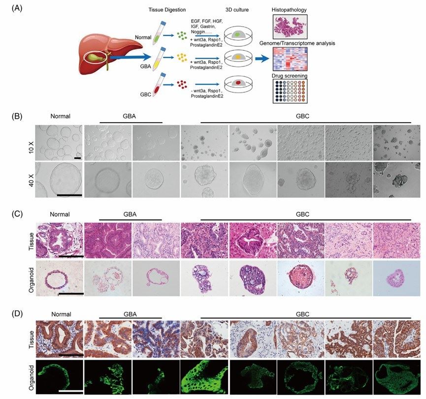 Establishment of organoids derived from human normal gallbladder, benign gallbladder adenoma (GBA) and gallbladder carcinoma (GBC) tissues.