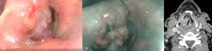 Visualization of the right hemilaryngeal lesion using videolaryngoscopy.