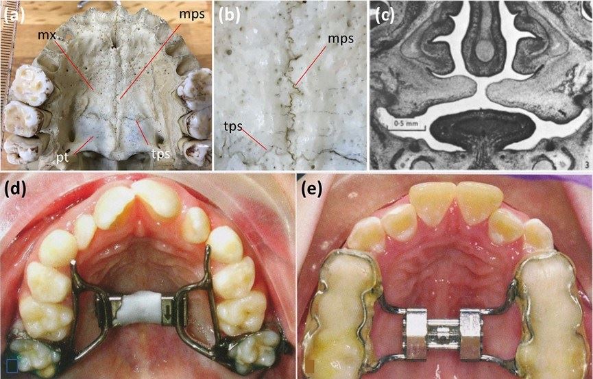 The palatal suture's anatomical significance in relation to developmental processes and clinical interventions.