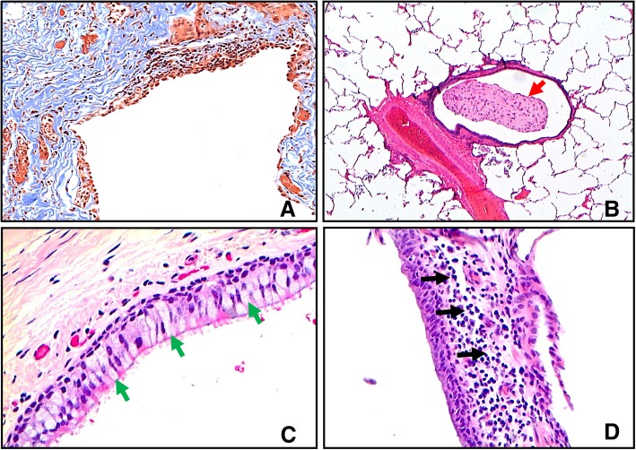 The microscopic characteristics of small airway pathology in Chronic Obstructive Pulmonary Disease (COPD).