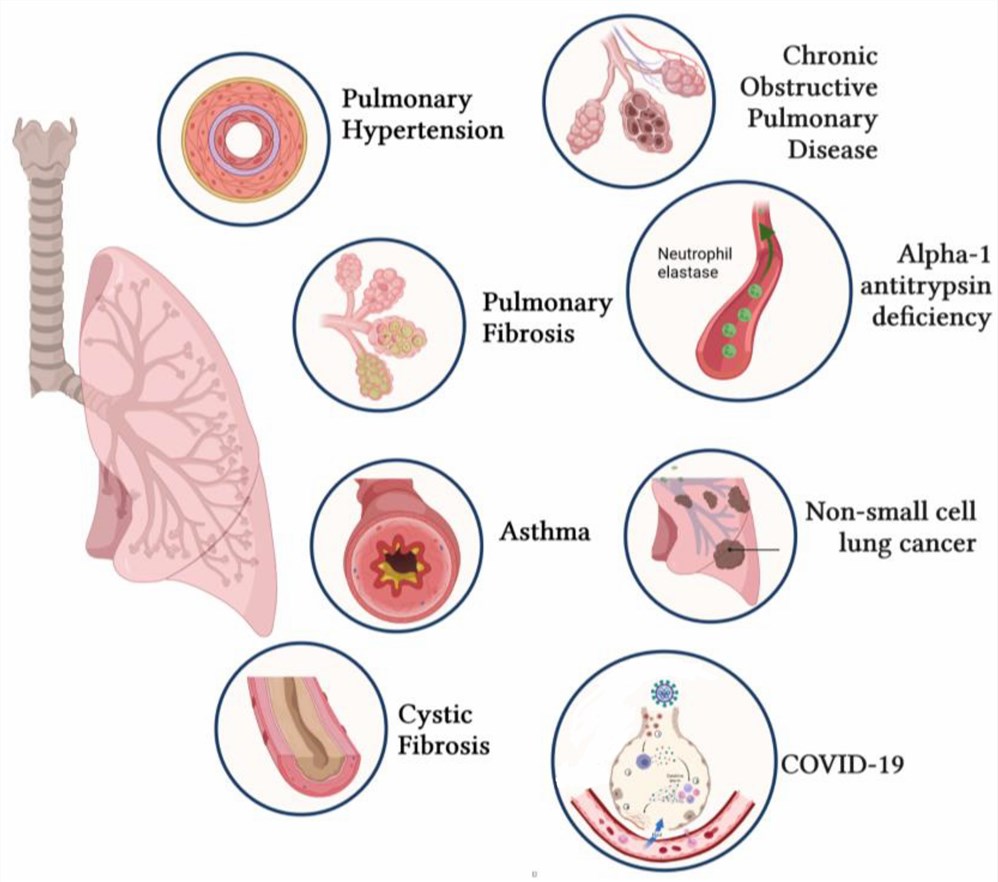 Common lung diseases.