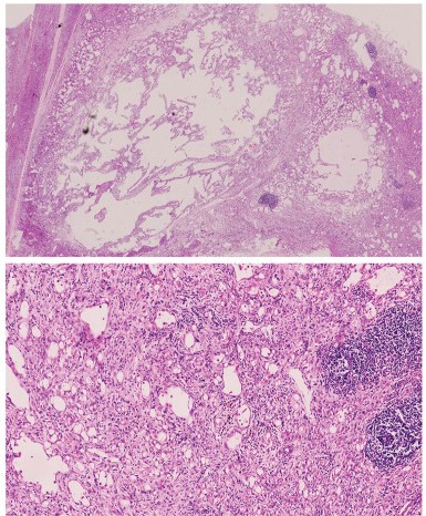 Characteristics observed in the tissue samples of adrenal adenomatoid tumors.