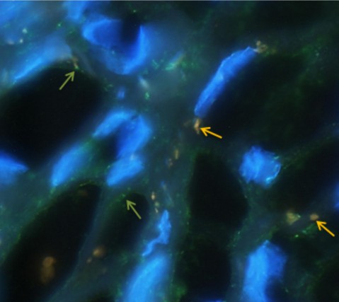 FISH analysis of a tonsillar tumor. (Hopken, 2018)