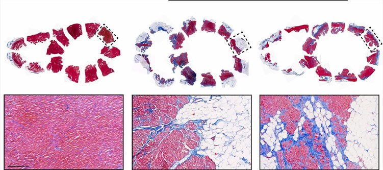 Cardiac fibro-fatty tissue remodelling in AC patients.