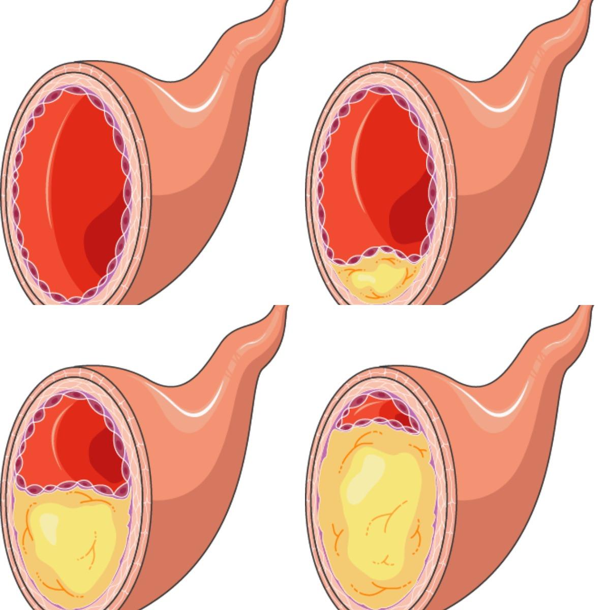 The process of atherosclerosis.