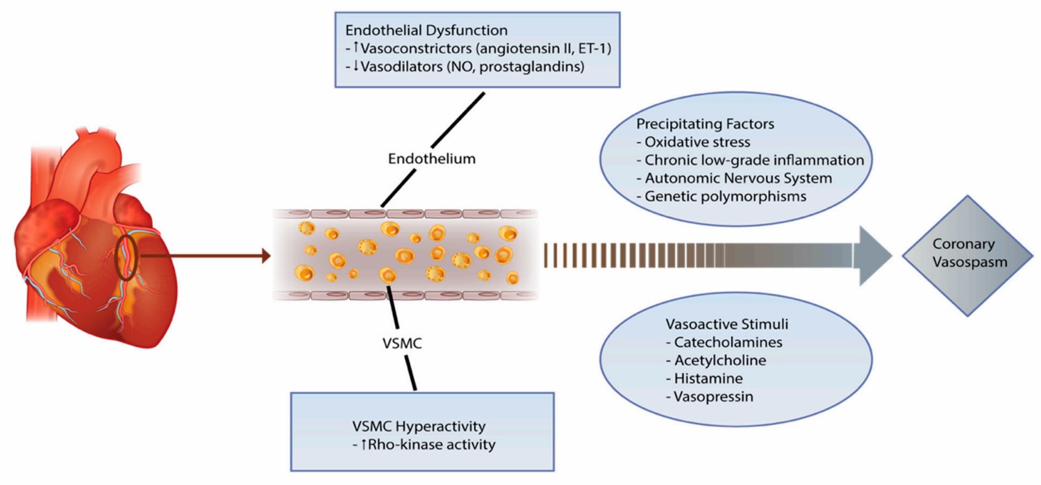 Complex pathophysiology of coronary vasospasm.