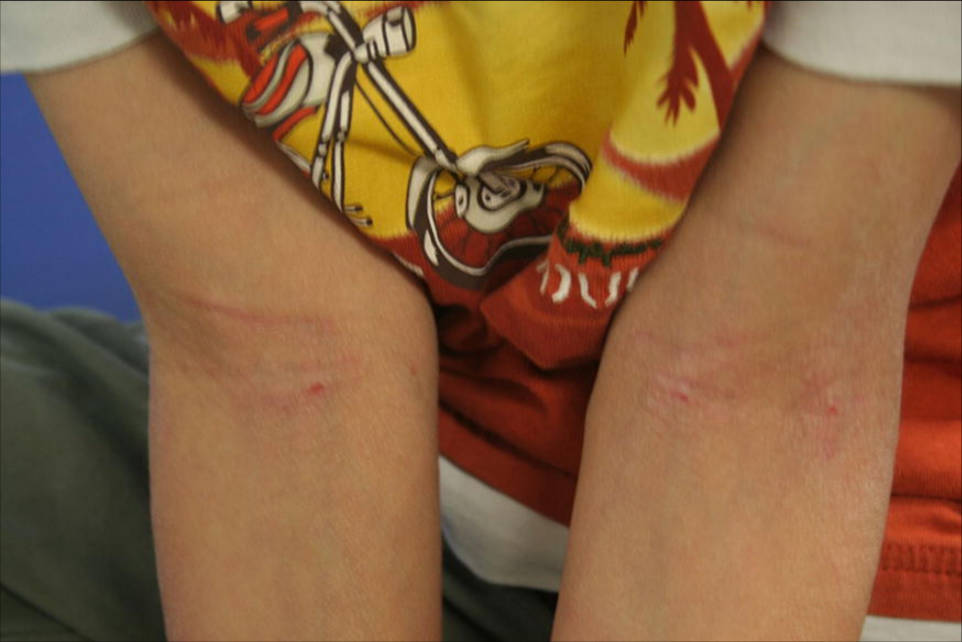 Fig 2. AD of the flexural surfaces of the extremities.(Kapur, et al., 2018)