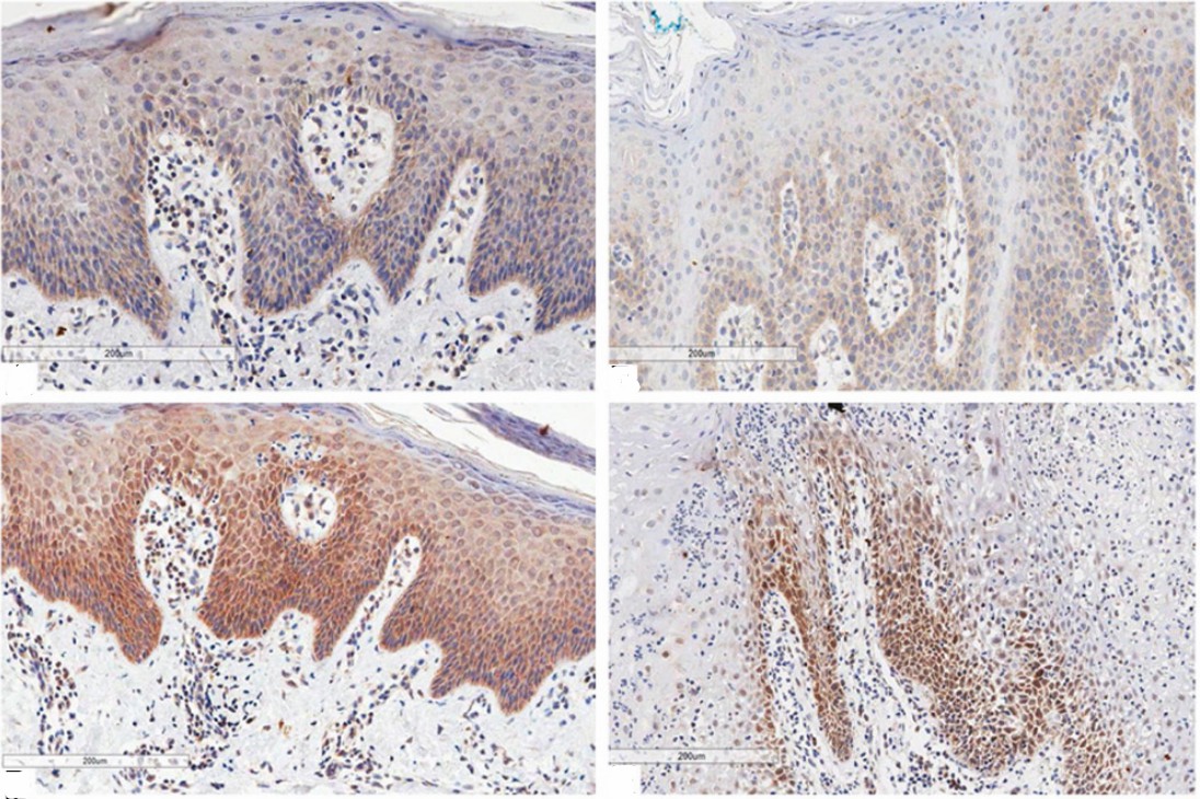 Fig 3. Immunohistochemical marking aspects of interleukins in psoriasis and geographic tongue. (Picciani, et al., 2019)