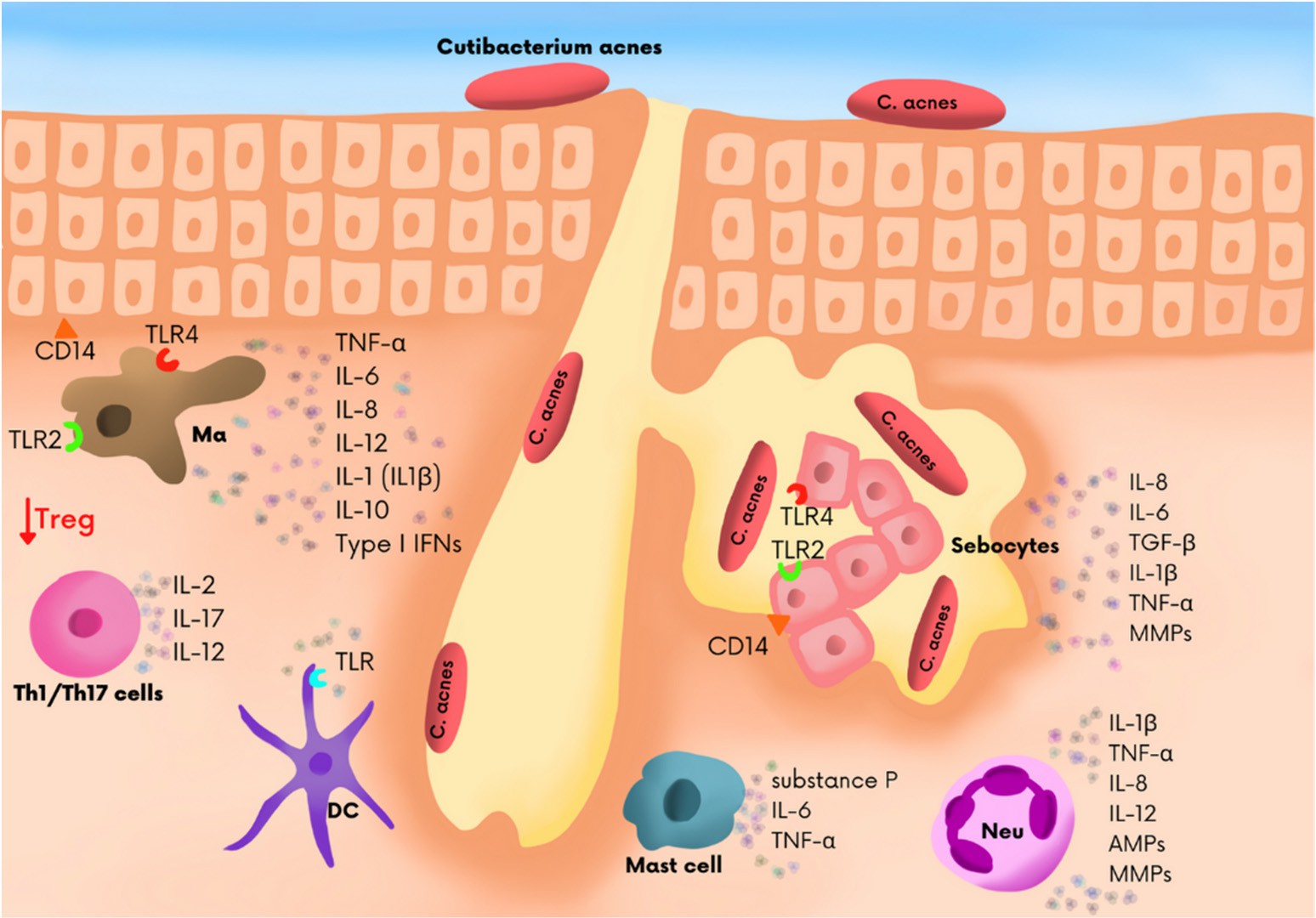 Immune cells in the sebaceous gland microenvironment of acne patients.