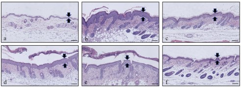 Histology of atopic dermatitis