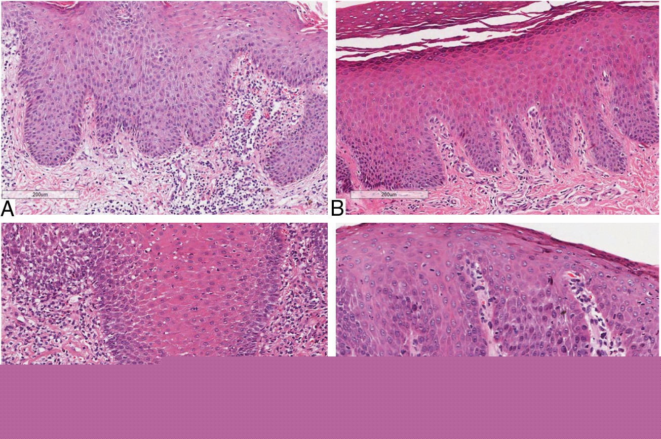 Fig 2. Histopathological aspects of inflammatory infiltrate. (Picciani, et al., 2019)
