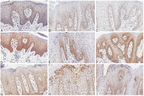 Fig 3. Immunohistochemical marking aspects of interleukins in psoriasis. (Picciani, et al., 2019)