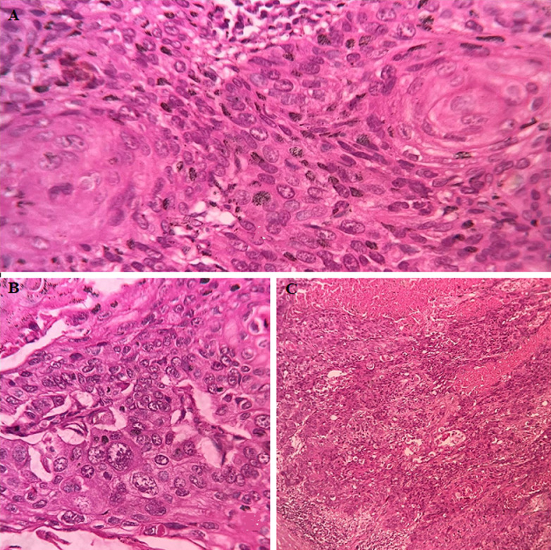 In renal squamous cell carcinoma tissue, irregular nest and malignant cells are arranged in sheet.