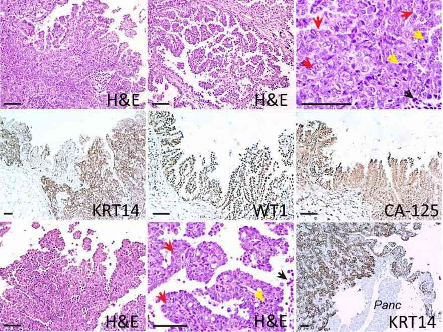 Fig 1. Histopathologic characterization of primary and metastatic HGSCs from TKO mice.