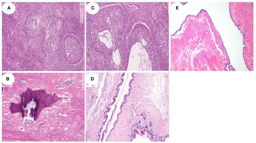 Fig 1. Microscopic characteristics of various BBT subtypes.