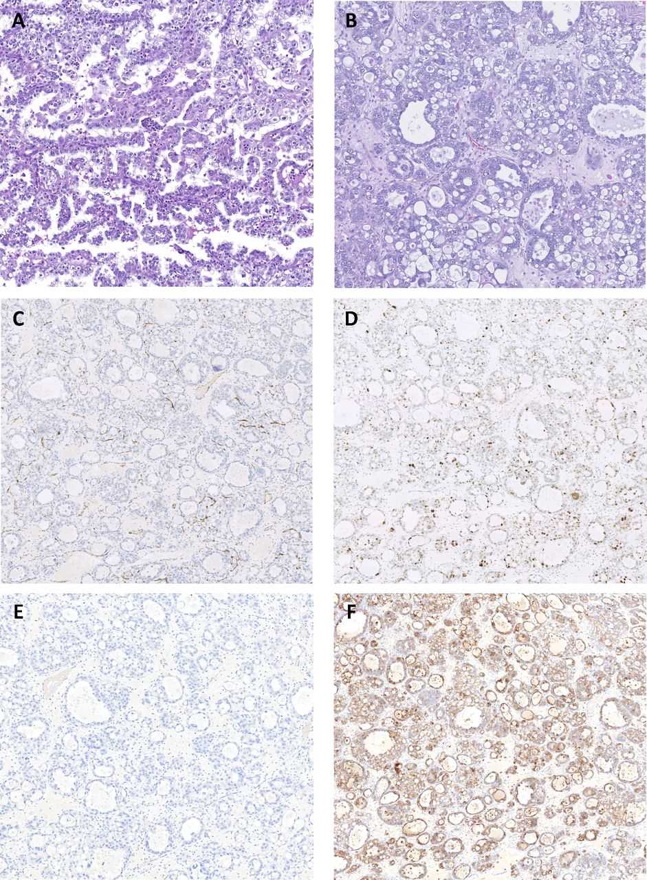 Fig 1. Histopathological features of clear cell carcinoma. (Iida, et al., 2021)