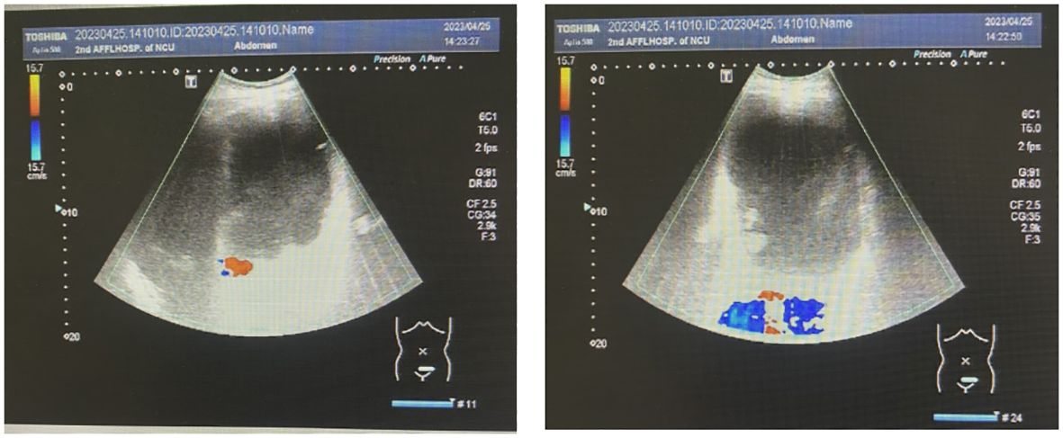 Fig 1. Gynecologic color ultrasonography suggested the presence of a serous cystadenoma originating from the right ovary. (Zhu, et al., 2024)