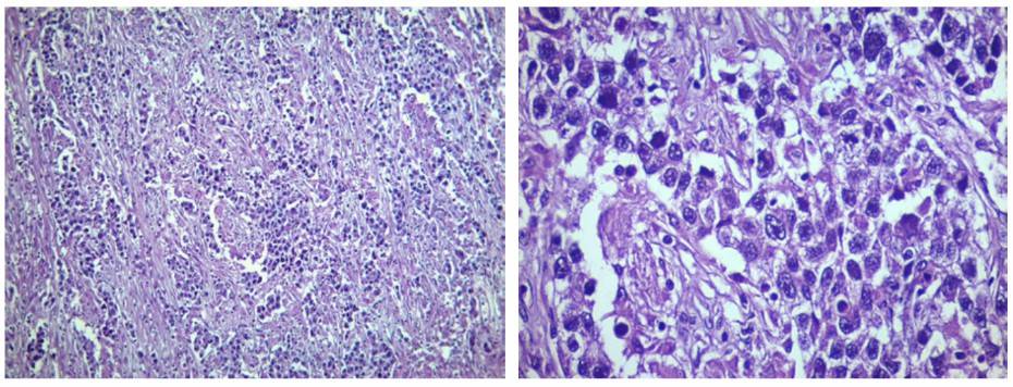 Fig 1. Histological features of tumor clusters and cell nests.