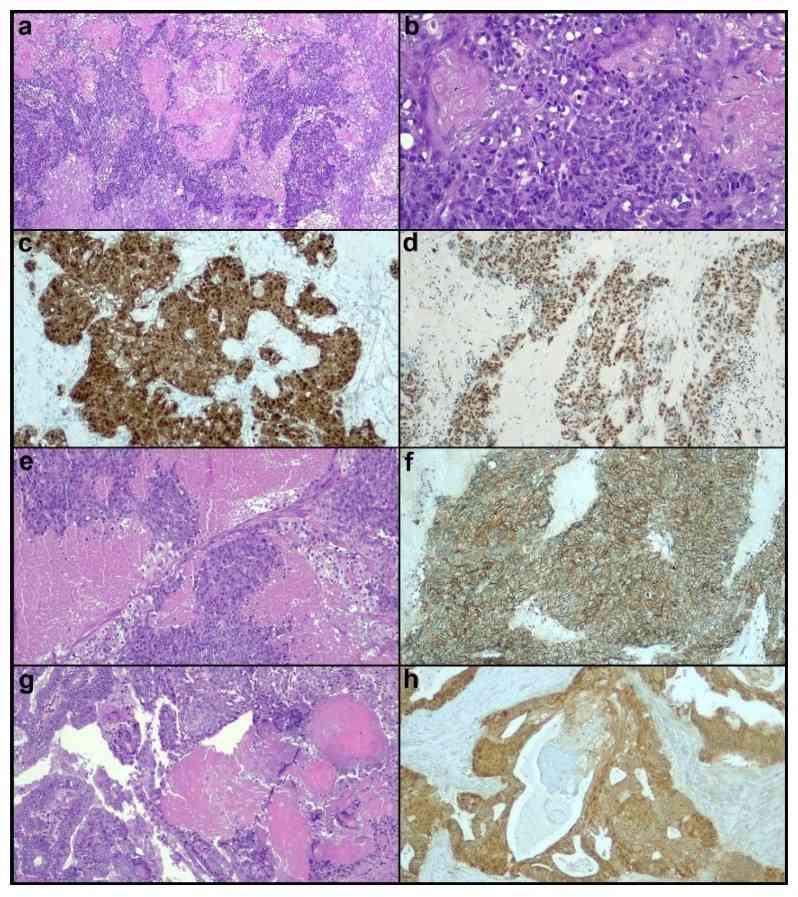 Fig 1. Histological and immunohistochemical features of ovarian PiMHEC and endometrioid carcinomas.