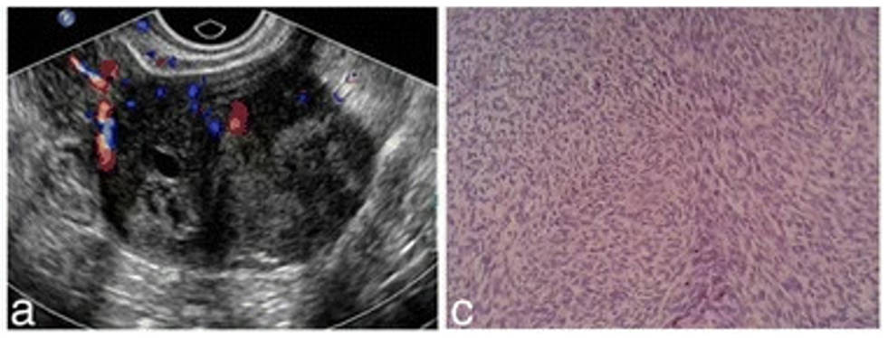 Fig 1. Ultrasound and pathological features of an ovarian cellular fibroma.