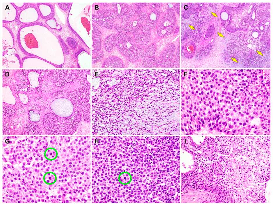 Fig 1. Microscopic analysis of the JGCT component in gynandroblastoma.