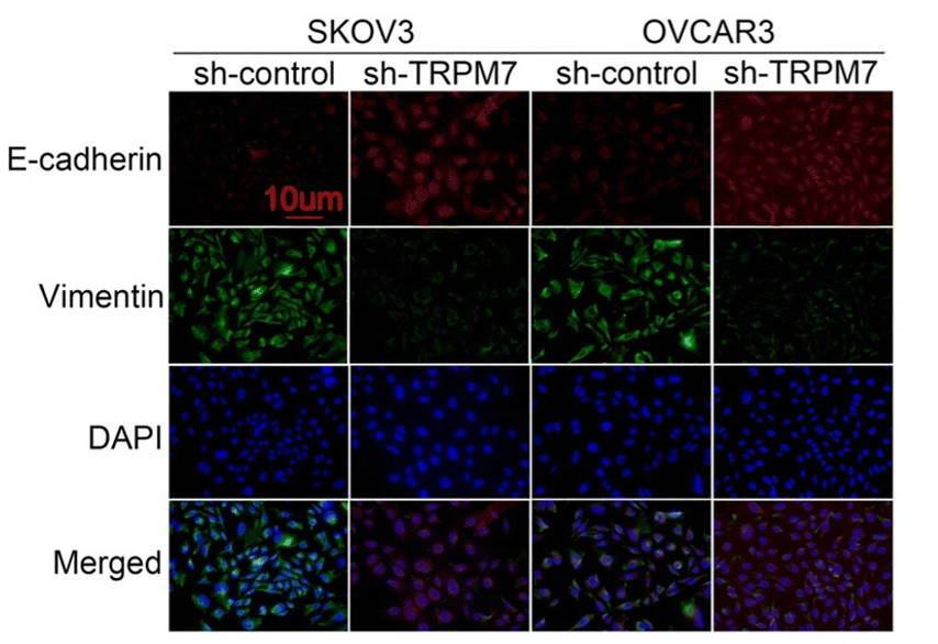 Fig 1. Immunofluorescent analysis of E-cadherin and Vimentin expression in ovarian cancer cells.