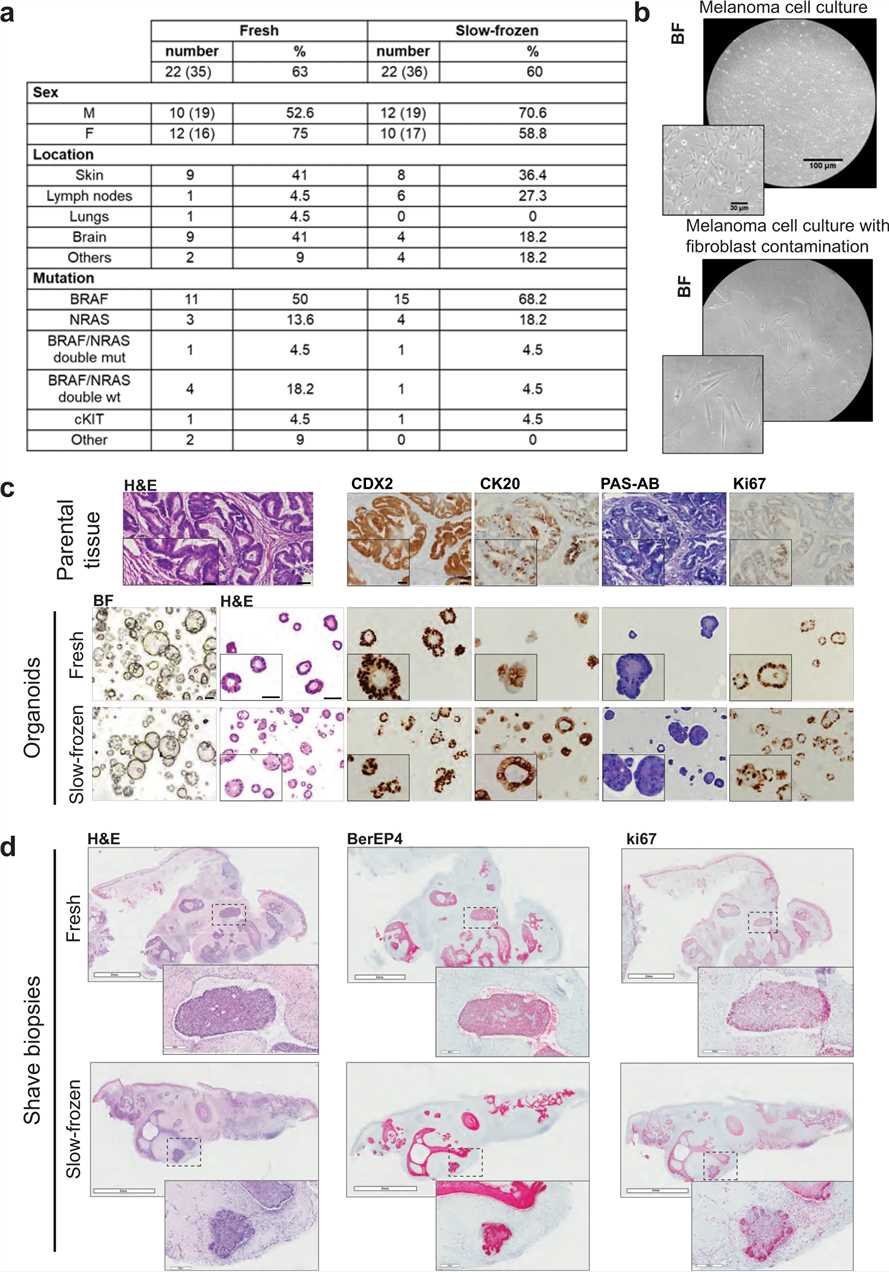 Fig 1. Microscopic photographs of shave biopsies from matched fresh or slow-frozen BCC.
