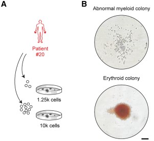 Schematic outlining leukemic progenitor cells assays performed with cells from patient #20.