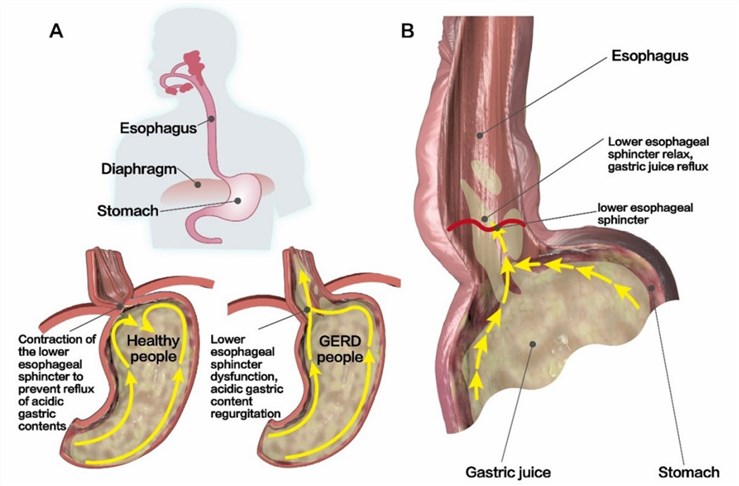 LES in healthy people and patients.
