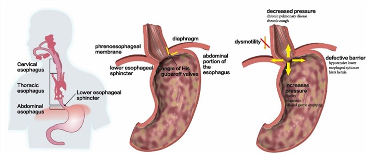 Patients with esophageal junction antireflux barrier disruption.