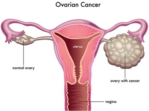 Ovarian cancer.