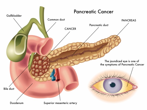 Pancreatic cancer.