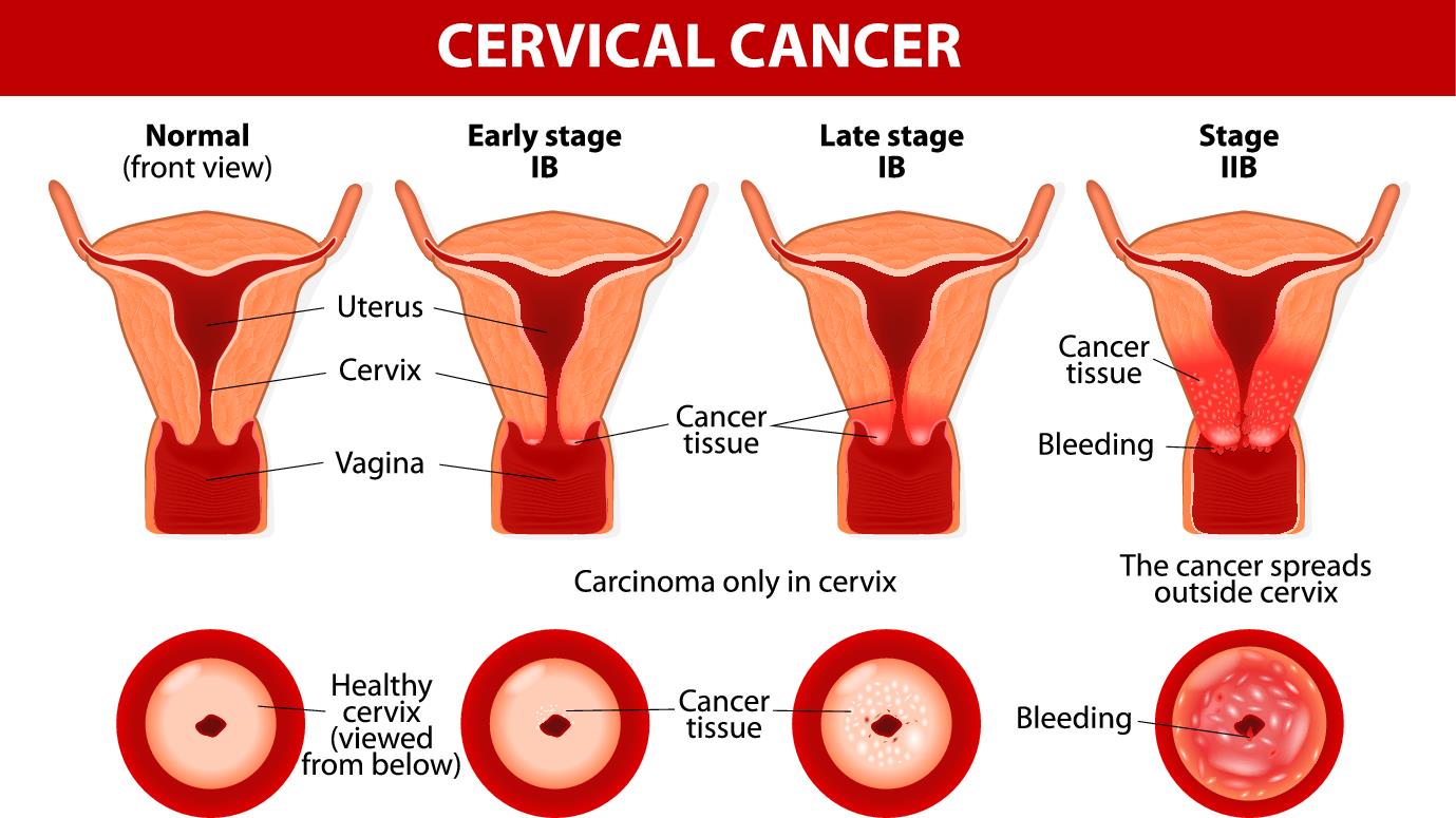 Cervical cancer.