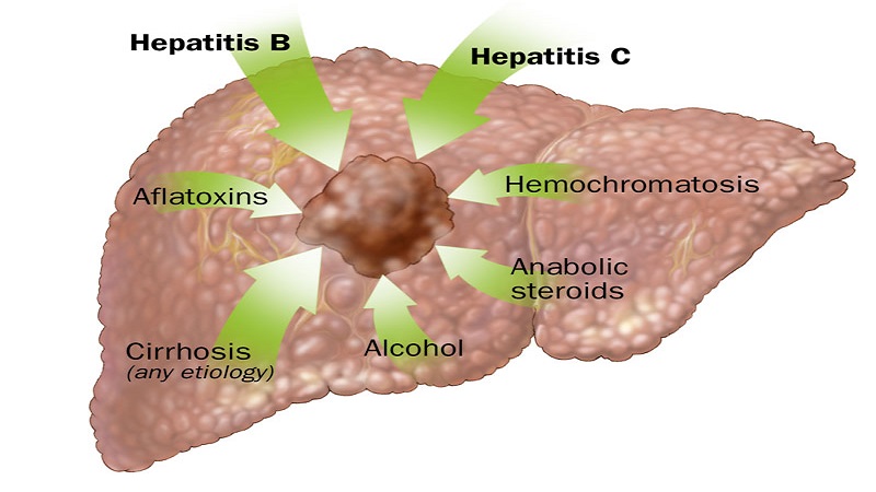 Causes of liver cancer 
