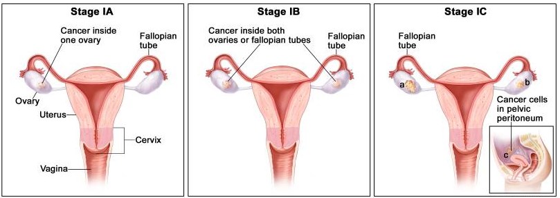 Definitions of fallopian tube cancer stage.