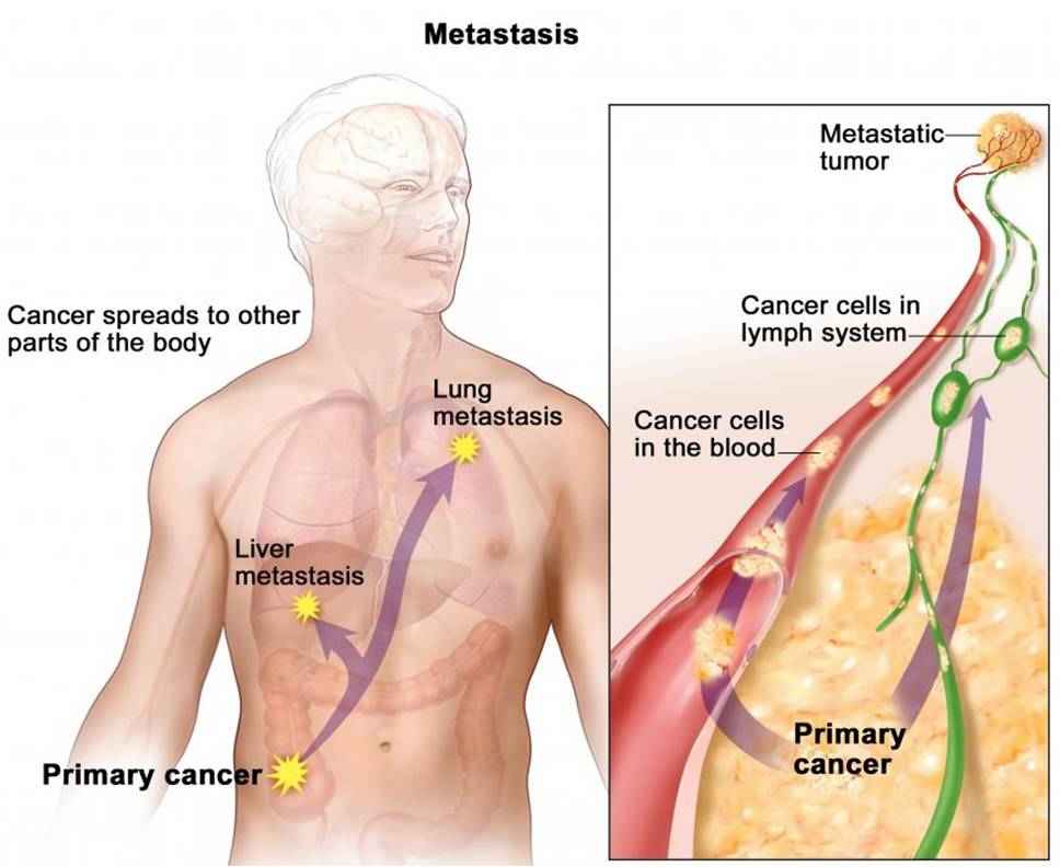 ADC Development for Metastatic Cancers
