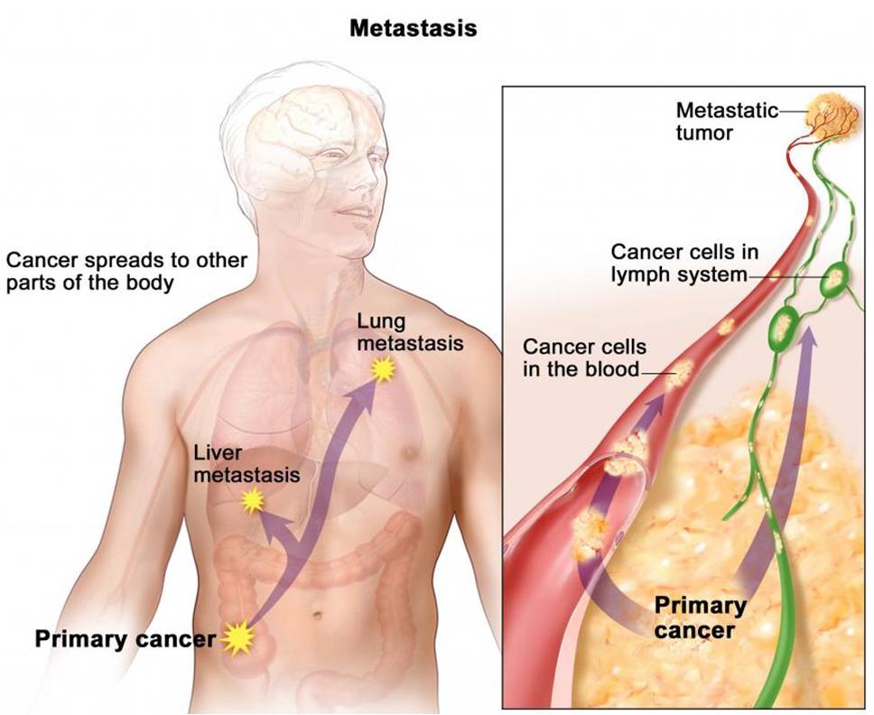 In metastasis, cancer cells travel through the blood or lymph system, and form metastatic tumors in other parts of the body.