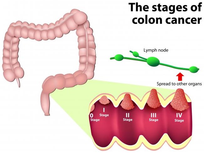 Different stages of CRC.