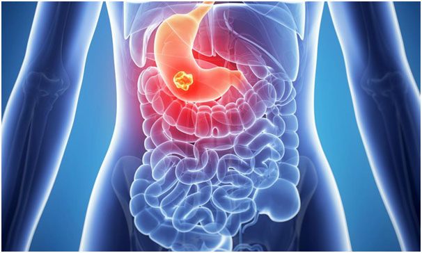 Gastrointestinal malignancies.